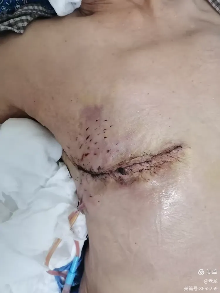 "80"后乳腺癌晚期患者重获新生